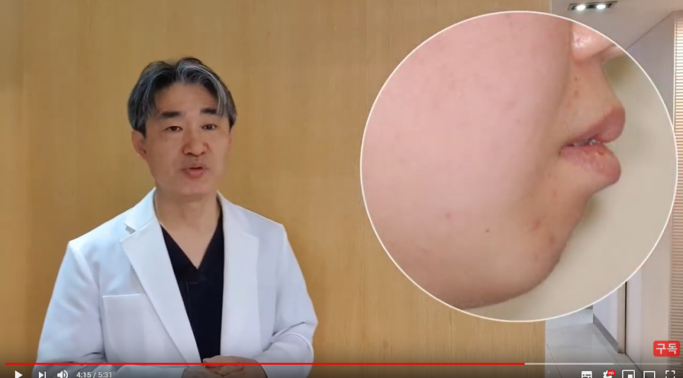 돌출입교정용나사(미니스크류) 많이 아파요? 관련 이미지 6