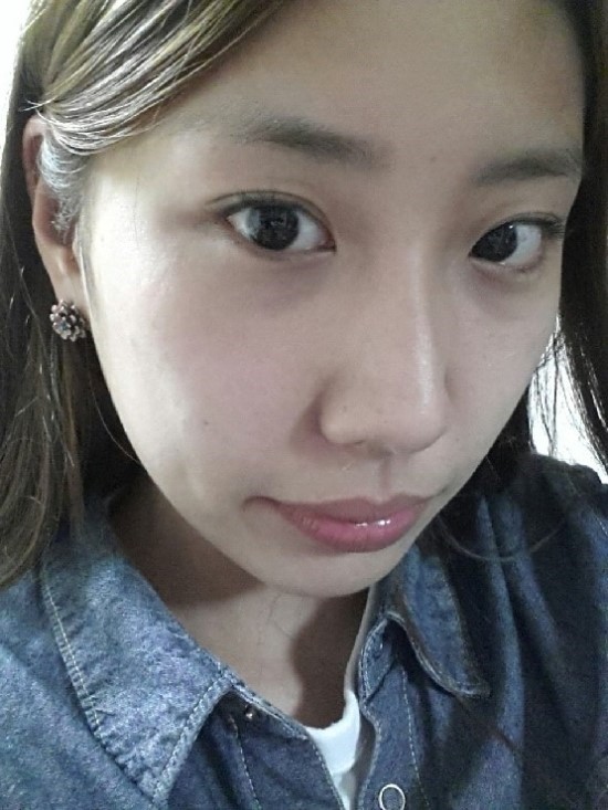 덧니교정후기(9) 거울 보는 낙으로 살고 있어요~ 관련 이미지 1