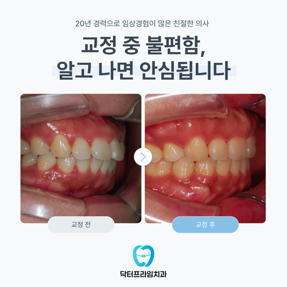교정 중 불편함, 알고 나면 안심됩니다 관련 이미지 1