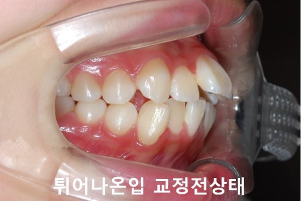 튀어나온입 교정과정 4단계요약 관련 이미지 2
