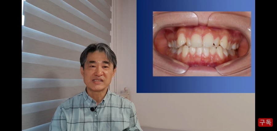 1년치아교정으로 예쁜미소 만드는 법! 관련 이미지 10