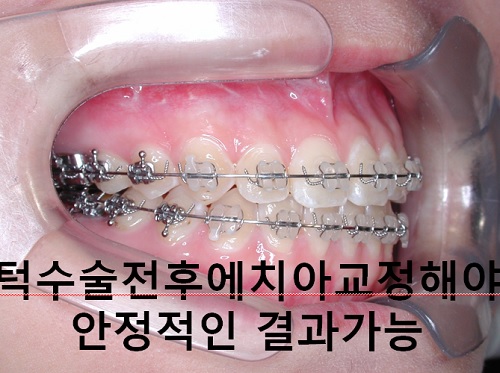 덧니와 주걱턱이 같이 있는 경우에 가장 효과적인 교정방법! 관련 이미지 19