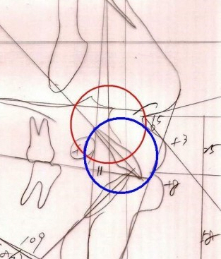 돌출된 앞니가 미운 입모양을 만드는 이유! 관련 이미지 1