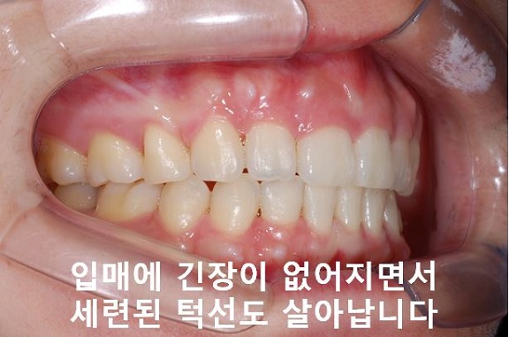 덧니교정이 곧 입매교정! 관련 이미지 14