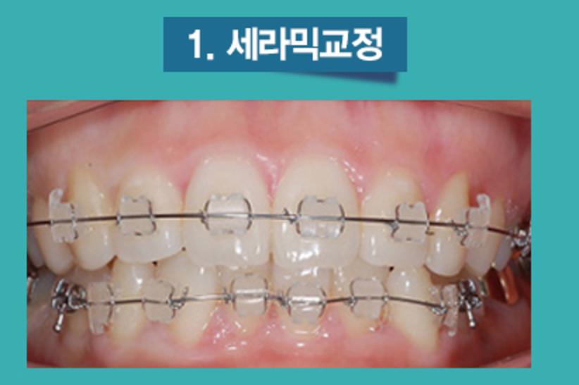 치아교정의 종류 4가지 1) 세라믹교정 2) 클리피시교정 3)설측교정 4) 투명교정 관련 이미지 2
