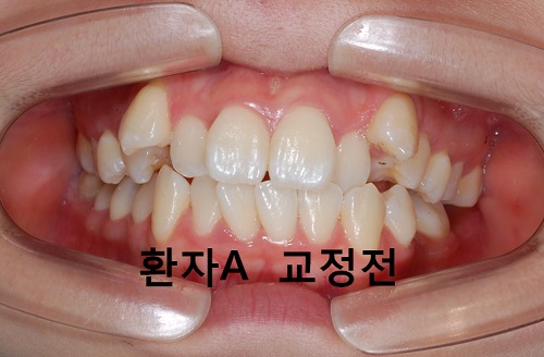 덧니와 주걱턱이 같이 있는 경우에 가장 효과적인 교정방법! 관련 이미지 10
