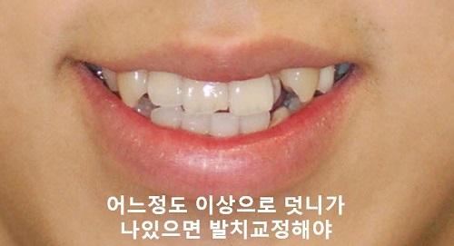 덧니교정과정, 4가지 요점만 알고 시작하세요! 관련 이미지 8