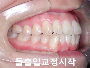 돌출입교정에 성공하는 방법 3가지! 관련 이미지 10