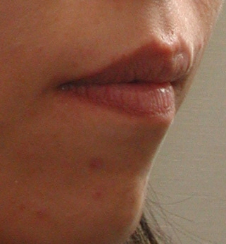 치아교정얼굴변화 관련 이미지 5