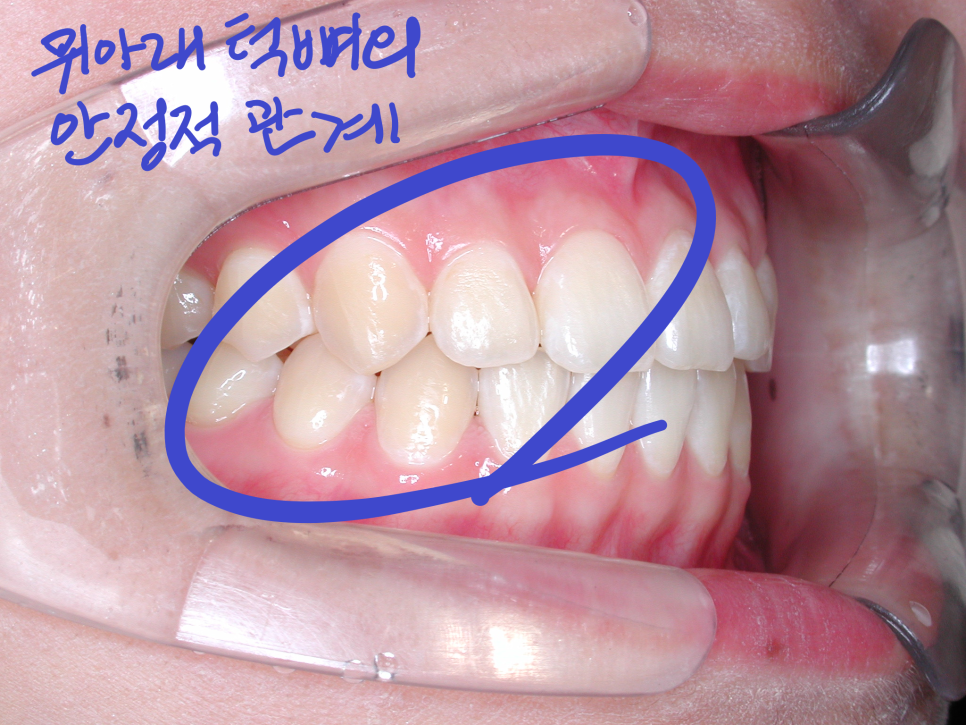 [치아교정] 양악수술과 치아교정의 은밀한 관계.주걱턱. 안면비대칭 환자들 치아교정 반드시 해야하나? 관련 이미지 3