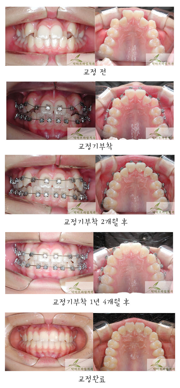 [치아교정후기] 비발치덧니교정사례 관련 이미지 1