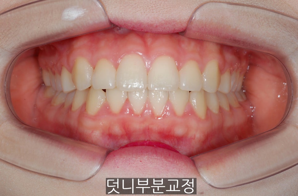 덧니부분교정하신 분들, 만족하시나요?? 관련 이미지 6
