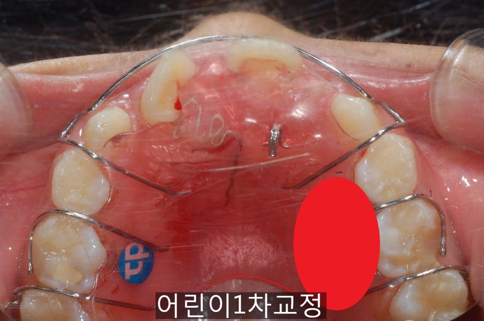 어린이 1차교정, 우리 아이도 필요할까!? 관련 이미지 3