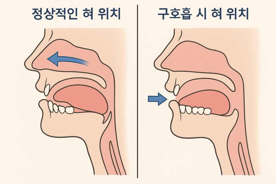 The Habit of Breathing Through the Mouth Damages the Face and Teeth (It Can Be Changed with Orthodontics) image 1