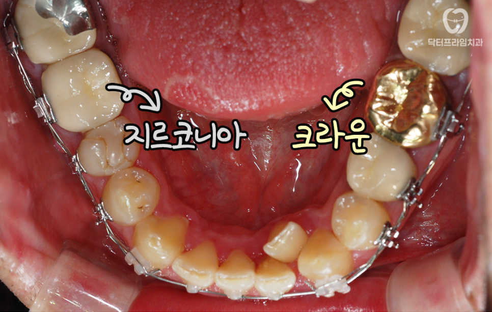 지르코니아, 골드크라운, 브릿지가 있어도 교정 가능한가요? &ndash; 주의할 점과 교정 후 관리까지 관련 이미지 1