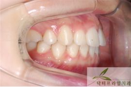 [돌출입교정] 10대 돌출입교정전후 관련 이미지 2