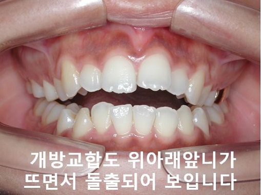 덧니교정이 곧 입매교정! 관련 이미지 15