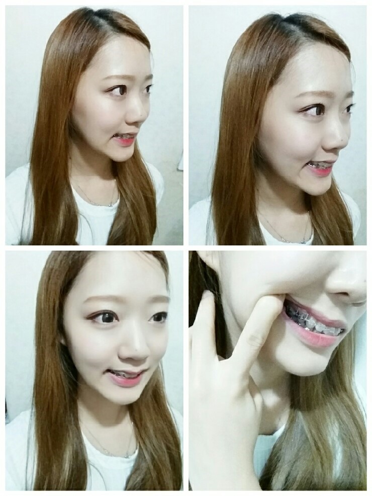 [치아교정후기] 앞니돌출교정후기(10) 관련 이미지 1