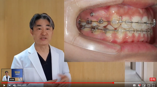 돌출입교정용나사(미니스크류) 많이 아파요? 관련 이미지 5