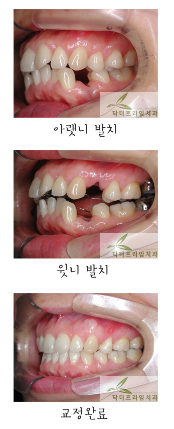 [치아교정후기] 보이지 않는 설측교정기로 돌출입교정 성공했어요~~! 관련 이미지 1