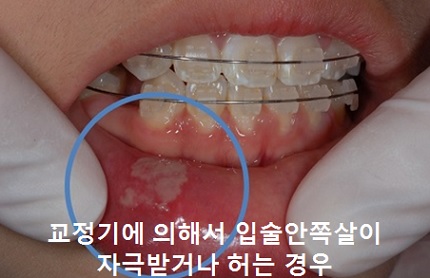 교정시작을 망설이게 하는 치아교정통증(2) 관련 이미지 7