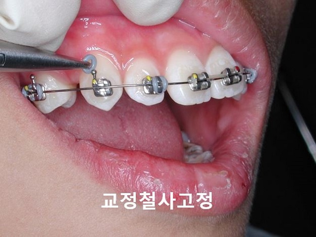 [교정기부착] 돌출입교정할때 교정기부착하는 법! 관련 이미지 9