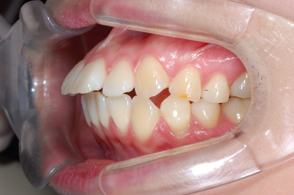 [돌출입교정후기] 강남역교정치과 닥터프라임치과에서의 돌출입교정후기, 20대여성, 교정기간 2년2개월, 클리피씨 교정기 관련 이미지 12