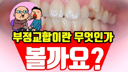 부정교합(덧니,돌출입,주걱턱,무턱,안면비대칭)은 무엇이며 왜 생기는가! 관련 이미지 1