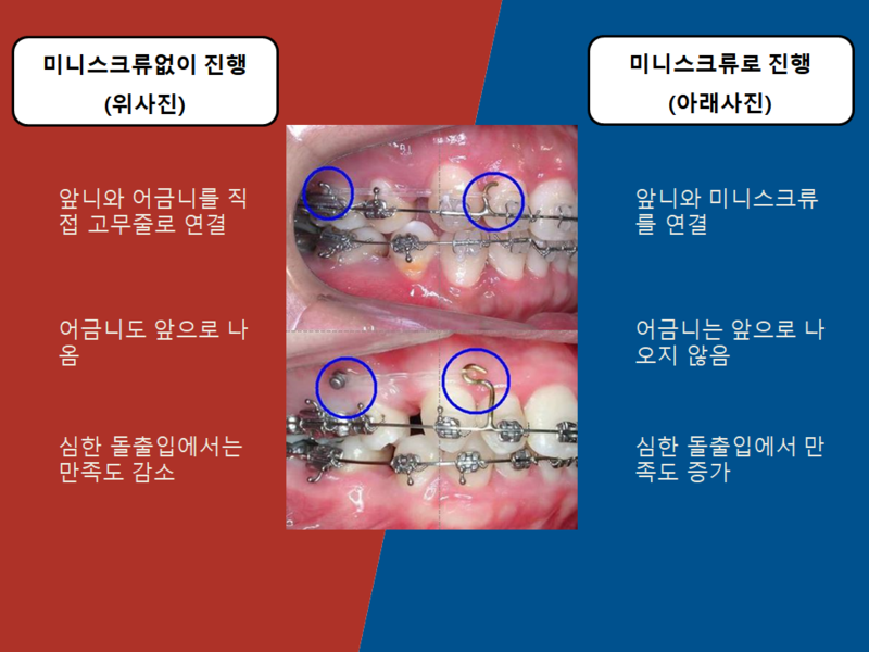[치아교정]치아교정미니스크류비교설명.미니스크류사용방법! 관련 이미지 1