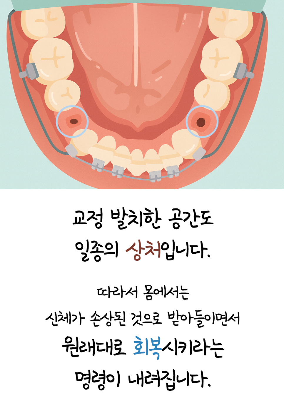 교정발치후 1달은 조심해야 하는 이유 관련 이미지 1
