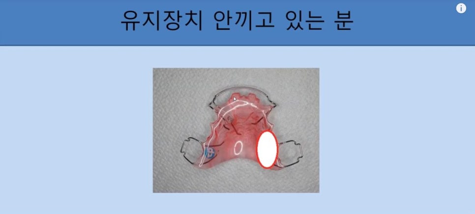 [치아교정] 치아교정 끝나고 요새 유지장치 안끼시는 분들 꼭 보시고 새출발하세요~~!! (돌출입교정, 덧니교정, 양악수술교정, 앞니교정한 분들 모두 해당됩니다) 관련 이미지 7