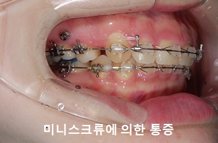 교정시작을 망설이게 하는 치아교정통증(2) 관련 이미지 11