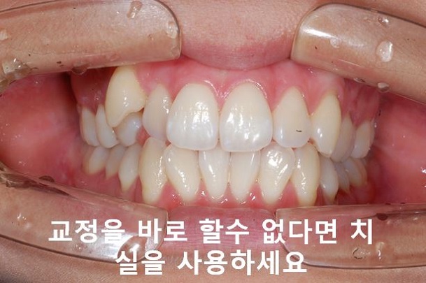 청소년, 덧니교정 안하면 이렇게 된다! 관련 이미지 10