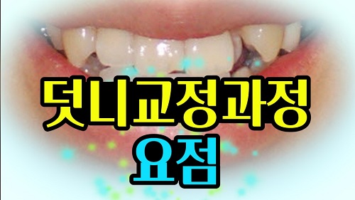 덧니교정과정, 4가지 요점만 알고 시작하세요! 관련 이미지 1