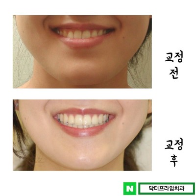 주걱턱교정 치료 보통은 양악수술 보다 하악을 먼저 생각 하지만… 관련 이미지 5
