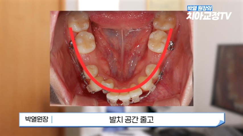 교정 중 불편함, 알고 나면 안심됩니다 관련 이미지 5