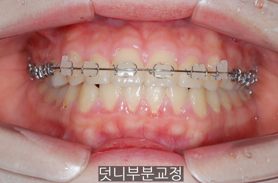 덧니부분교정하신 분들, 만족하시나요?? 관련 이미지 3