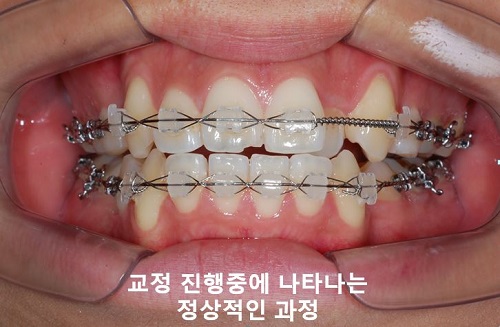 덧니교정과정, 4가지 요점만 알고 시작하세요! 관련 이미지 18