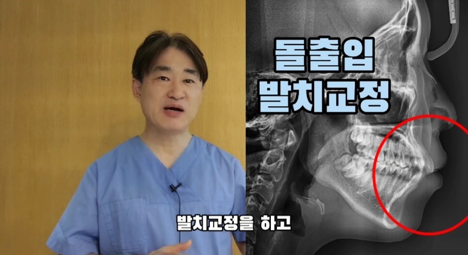 돌출입 교정 하실 분, 이것만은 꼭 알고 시작해야 합니다! 관련 이미지 2