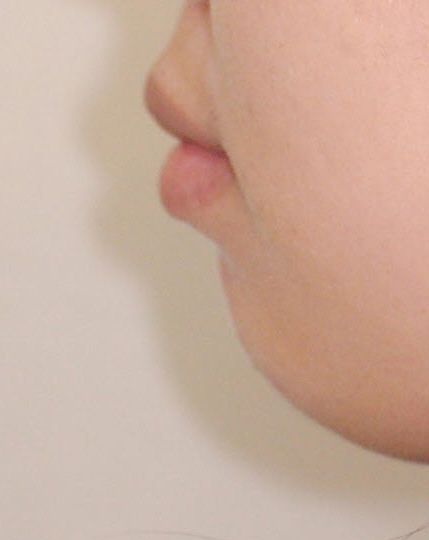 무턱수술했나요? 아니요, 무턱교정만 했어요! 관련 이미지 36
