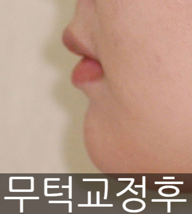 무턱수술했나요? 아니요, 무턱교정만 했어요! 관련 이미지 2