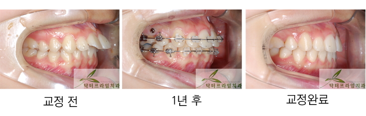 [치아교정후기] 돌출된 앞니때문에 학교생활 부적응 우려. 치아파절(치아깨짐)도 조심해야! 관련 이미지 2