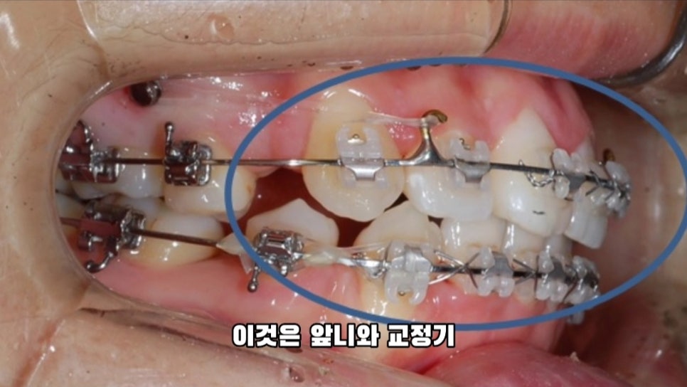 돌출입 교정 하실 분, 이것만은 꼭 알고 시작해야 합니다! 관련 이미지 5