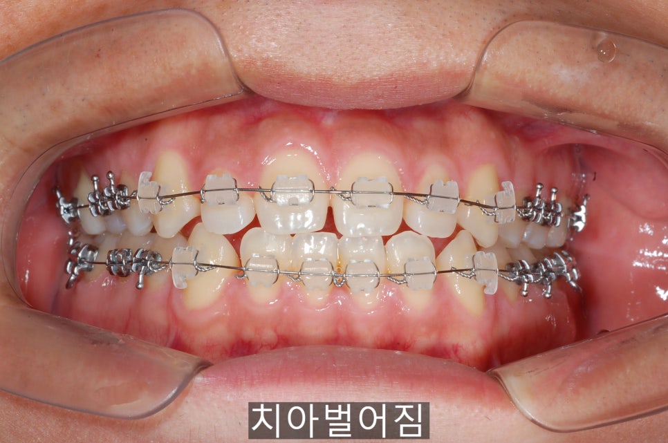 20세이상의 치아벌어짐, 교정 Vs 라미네이트! 관련 이미지 4