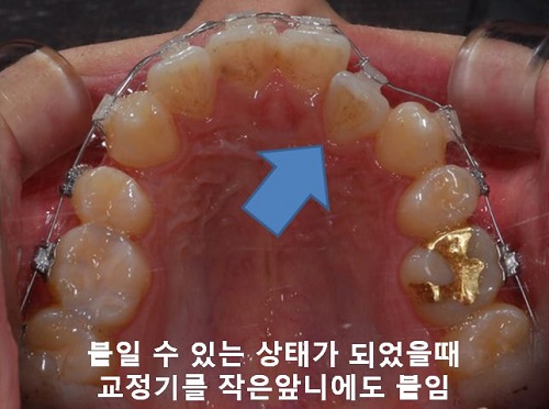 덧니교정과정, 4가지 요점만 알고 시작하세요! 관련 이미지 14