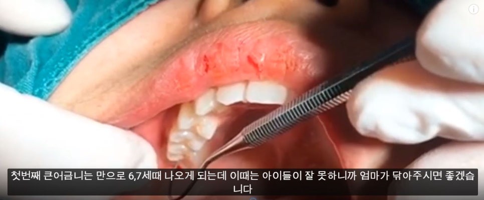 [치아교정] 치아교정중 충치예방. 어금니 올바른 칫솔질 꼭 배우세요!! 관련 이미지 2