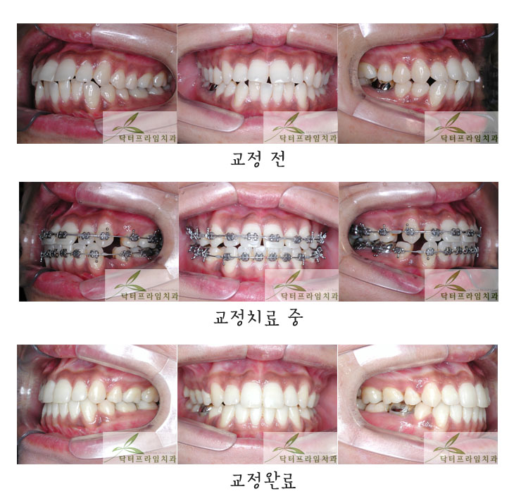[치아교정후기] 교정기간 1년3개월만에 끝!! 아주 빨리 끝난 경우예요~~ 관련 이미지 1