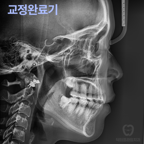 강남역 교정치과, 돌출입 발치교정하면 합죽해진다? 그렇습니다. 사실입니다 관련 이미지 4