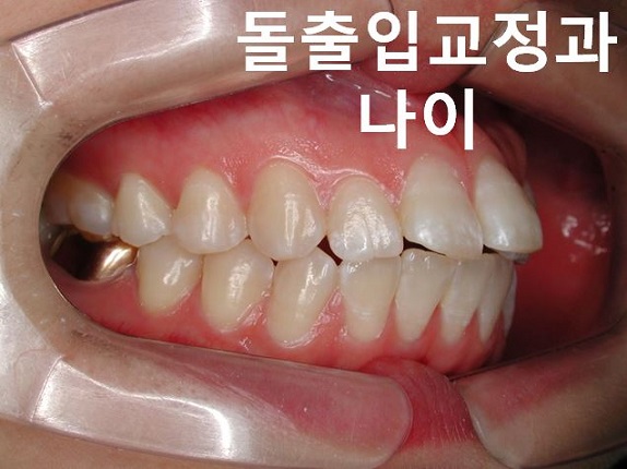 돌출입교정의 효과적인 시기! 관련 이미지 10