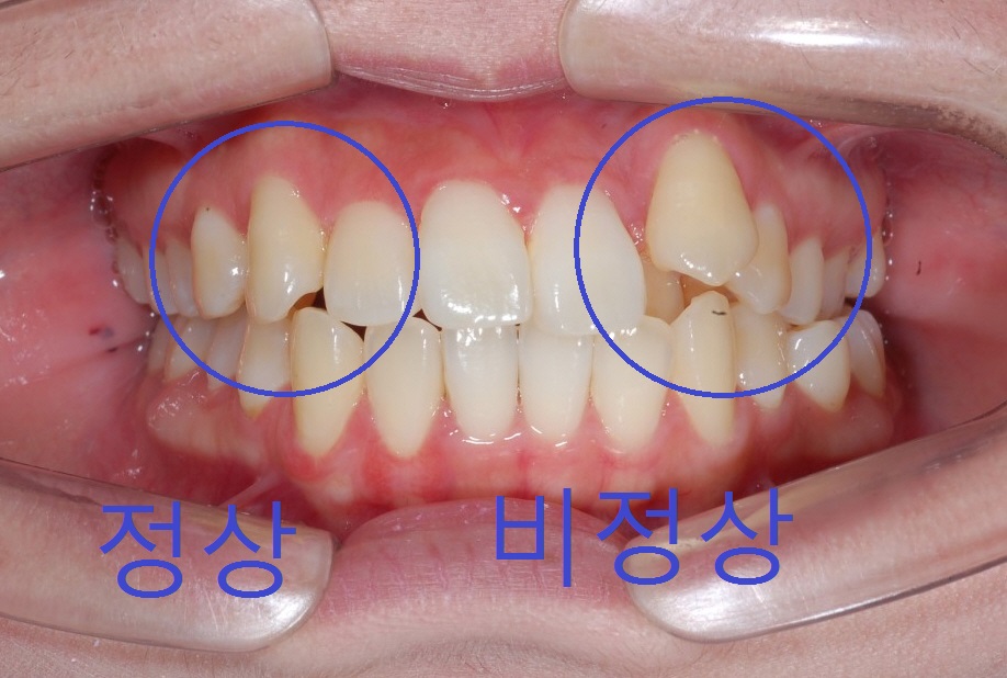 [송곳니덧니] 한쪽송곳니만 덧니로 나온 이유는 과연 무엇일까?? 관련 이미지 1